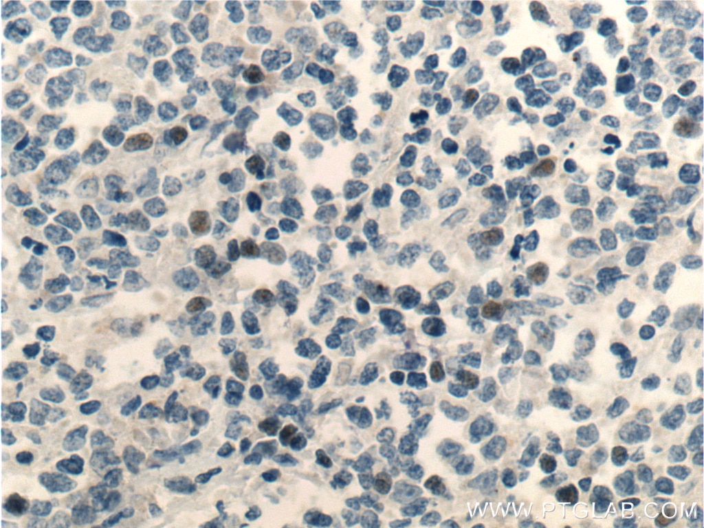 Immunohistochemistry (IHC) staining of human lymphoma tissue using MSC Polyclonal antibody (25028-1-AP)