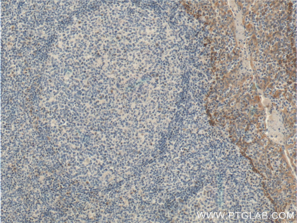 Immunohistochemistry (IHC) staining of human tonsillitis tissue using MSC Polyclonal antibody (25028-1-AP)