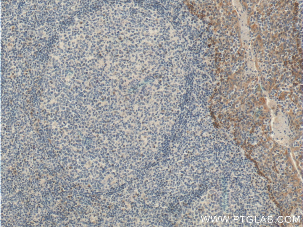 IHC staining of human tonsillitis using 25028-1-AP