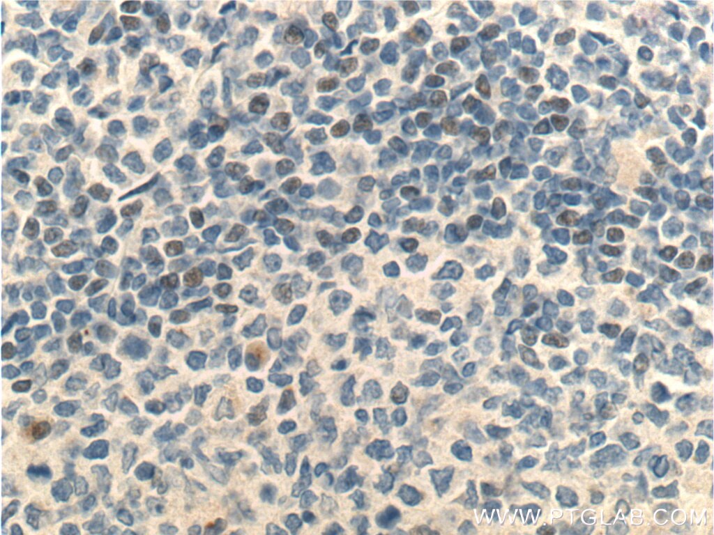 IHC staining of human tonsillitis using 25028-1-AP