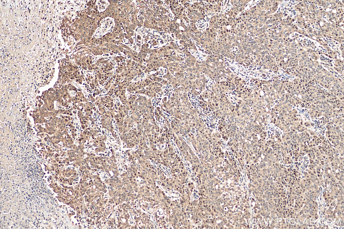 Immunohistochemistry (IHC) staining of human stomach cancer tissue using MSH2 Polyclonal antibody (15520-1-AP)