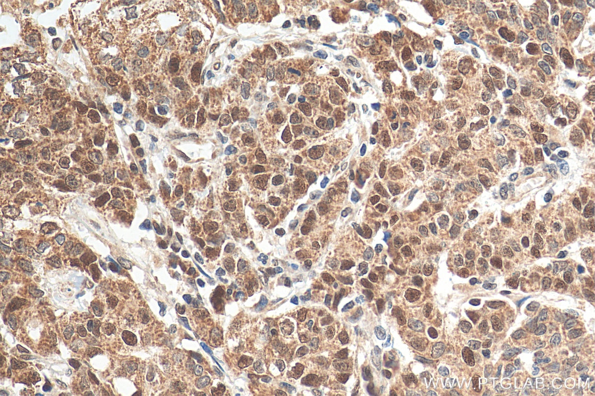 Immunohistochemistry (IHC) staining of human stomach cancer tissue using MSH2 Polyclonal antibody (15520-1-AP)