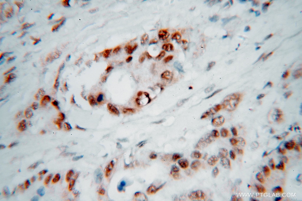 IHC staining of human colon cancer using 15520-1-AP