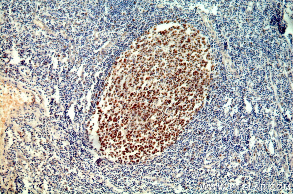 Immunohistochemistry (IHC) staining of human tonsil tissue using MSH2 Polyclonal antibody (15520-1-AP)