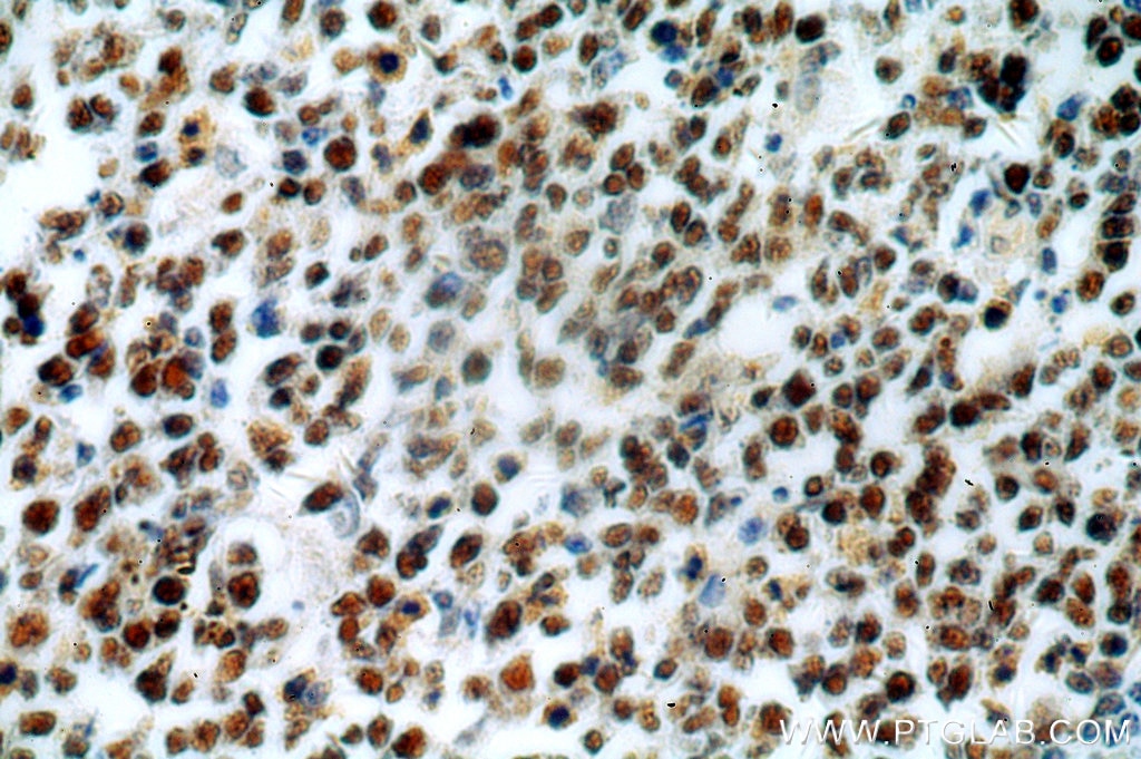Immunohistochemistry (IHC) staining of human tonsil tissue using MSH2 Polyclonal antibody (15520-1-AP)
