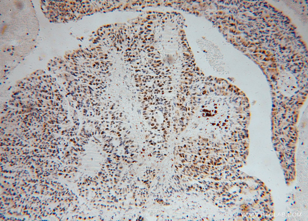 IHC staining of human colon cancer using 15520-1-AP