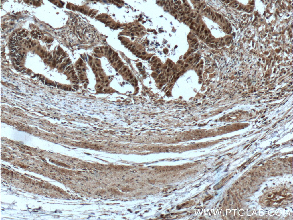 Immunohistochemistry (IHC) staining of human colon cancer tissue using MSH2 Monoclonal antibody (60161-1-Ig)