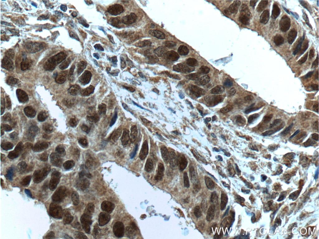 Immunohistochemistry (IHC) staining of human colon cancer tissue using MSH2 Monoclonal antibody (60161-1-Ig)