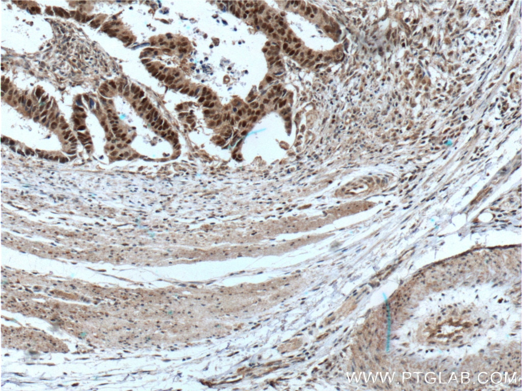 Immunohistochemistry (IHC) staining of human colon cancer tissue using MSH2 Monoclonal antibody (60161-1-Ig)