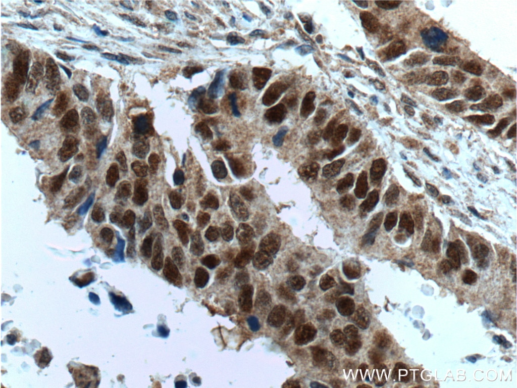 Immunohistochemistry (IHC) staining of human colon cancer tissue using MSH2 Monoclonal antibody (60161-1-Ig)