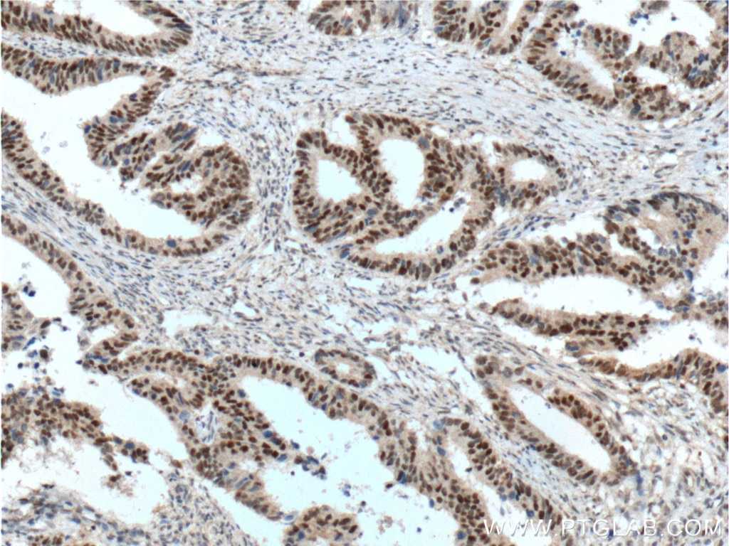 Immunohistochemistry (IHC) staining of human colon cancer tissue using MSH2 Monoclonal antibody (60161-1-Ig)