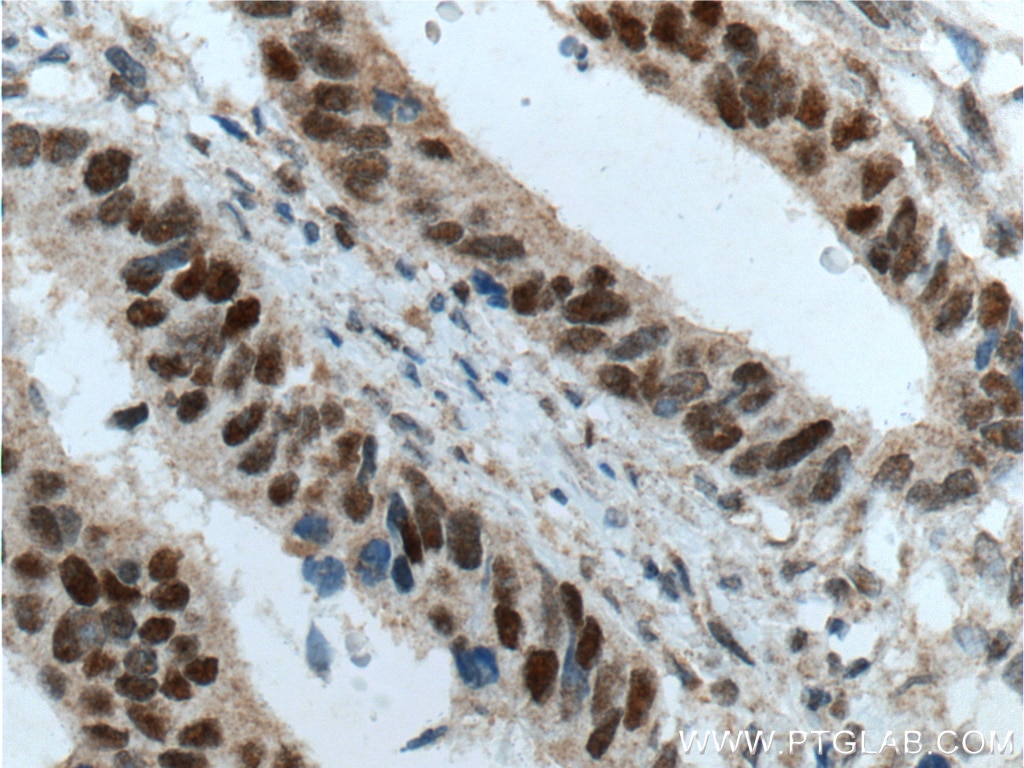 Immunohistochemistry (IHC) staining of human colon cancer tissue using MSH2 Monoclonal antibody (60161-1-Ig)