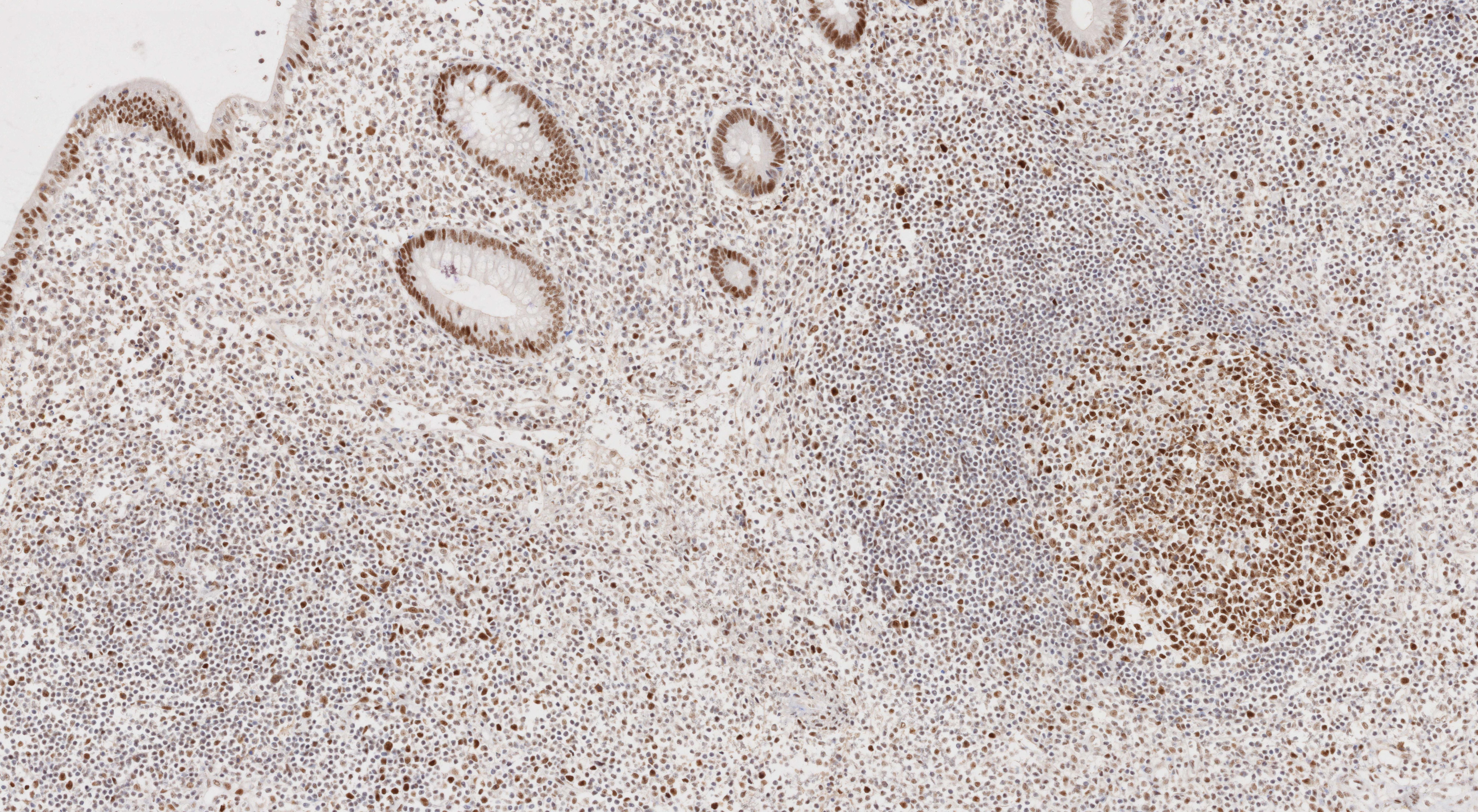 Immunohistochemistry (IHC) staining of human appendicitis tissue using MSH2 Monoclonal antibody (60161-2-Ig)