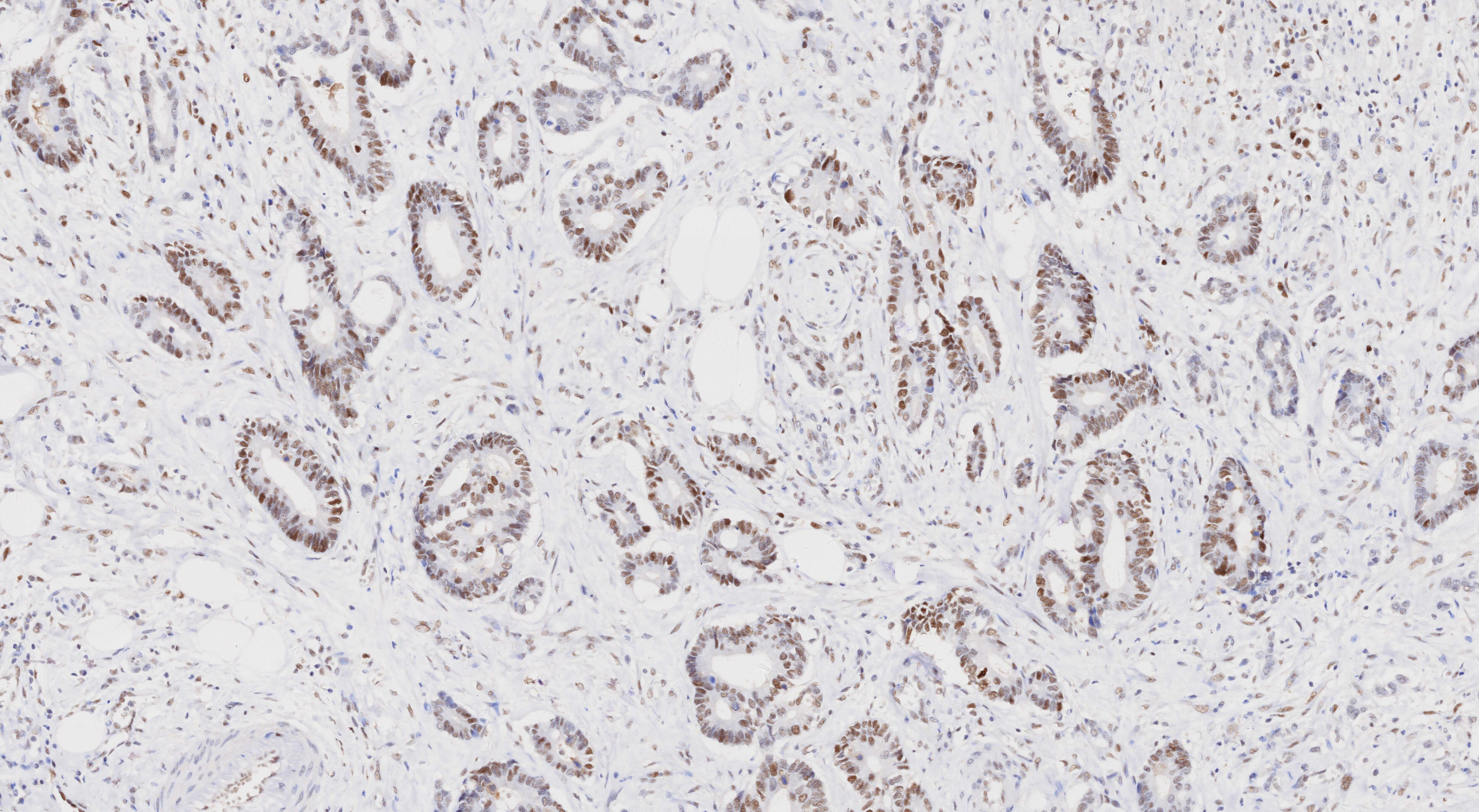 Immunohistochemistry (IHC) staining of human rectal cancer tissue using MSH2 Monoclonal antibody (60161-2-Ig)