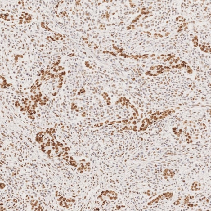 Immunohistochemistry (IHC) staining of human stomach cancer tissue using MSH2 Recombinant monoclonal antibody (82775-1-RR)