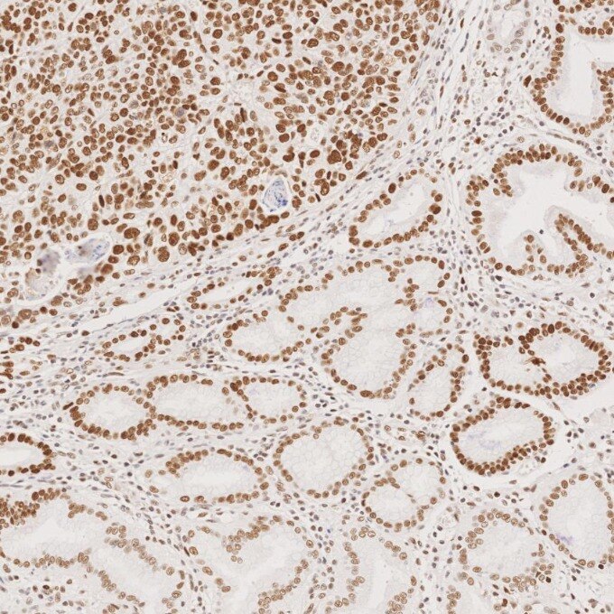 Immunohistochemistry (IHC) staining of human stomach cancer tissue using MSH2 Recombinant monoclonal antibody (82775-1-RR)