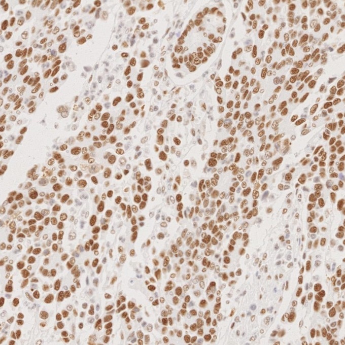 Immunohistochemistry (IHC) staining of human stomach cancer tissue using MSH2 Recombinant monoclonal antibody (82775-1-RR)