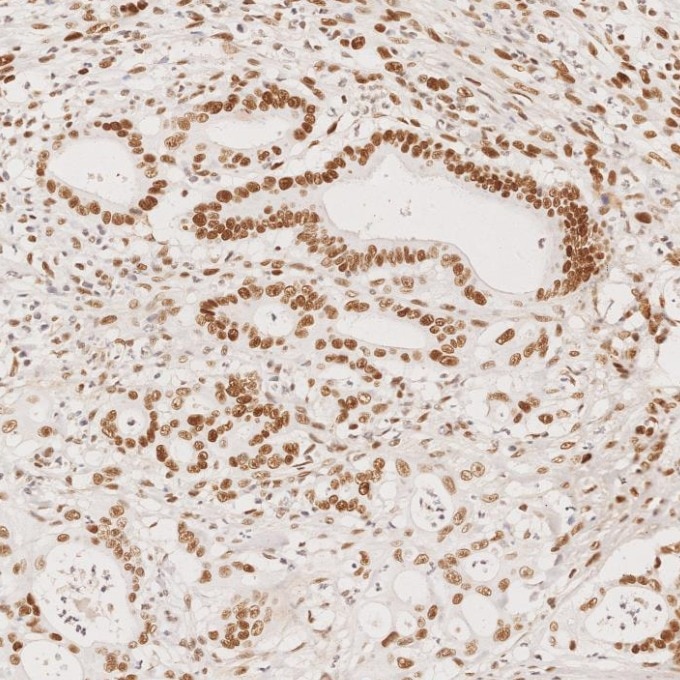 Immunohistochemistry (IHC) staining of human colorectal cancer tissue using MSH2 Recombinant monoclonal antibody (82775-1-RR)
