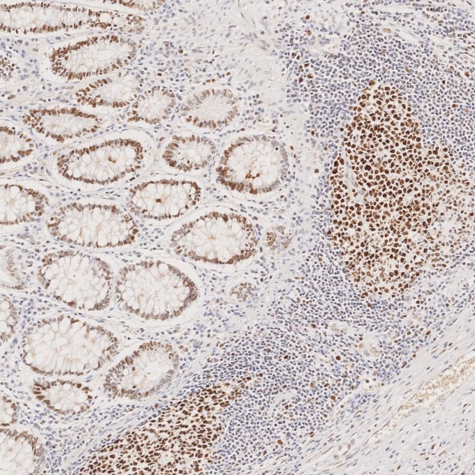 Immunohistochemistry (IHC) staining of human colorectal cancer tissue using MSH2 Recombinant monoclonal antibody (82775-1-RR)
