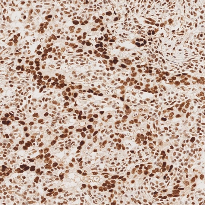 Immunohistochemistry (IHC) staining of human stomach cancer tissue using MSH2 Recombinant monoclonal antibody (82775-1-RR)