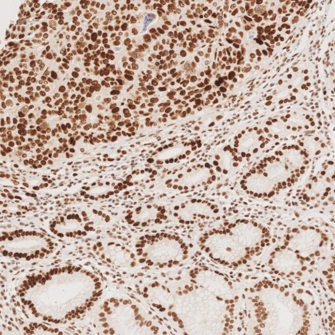 Immunohistochemistry (IHC) staining of human stomach cancer tissue using MSH2 Recombinant monoclonal antibody (82775-1-RR)