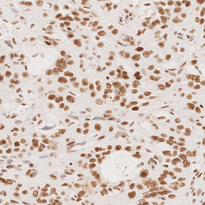 Immunohistochemistry (IHC) staining of human ovary cancer tissue using MSH2 Recombinant monoclonal antibody (82775-1-RR)