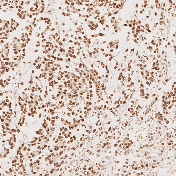 Immunohistochemistry (IHC) staining of human stomach cancer tissue using MSH2 Recombinant monoclonal antibody (82775-1-RR)