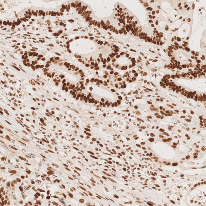 Immunohistochemistry (IHC) staining of human colorectal cancer tissue using MSH2 Recombinant monoclonal antibody (82775-1-RR)