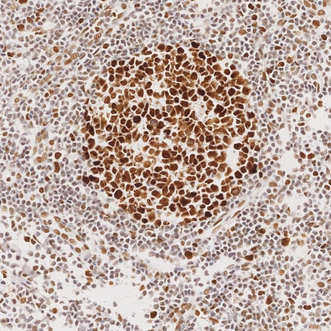 Immunohistochemistry (IHC) staining of human tonsillitis tissue using MSH2 Recombinant monoclonal antibody (82775-1-RR)