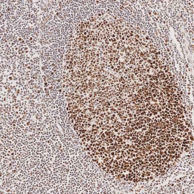 Immunohistochemistry (IHC) staining of human tonsillitis tissue using MSH2 Recombinant monoclonal antibody (82775-1-RR)