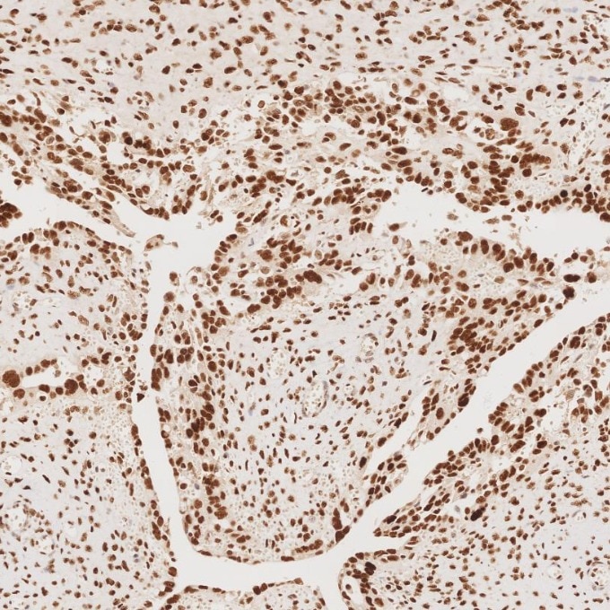 Immunohistochemistry (IHC) staining of human ovary cancer tissue using MSH2 Recombinant monoclonal antibody (82775-1-RR)