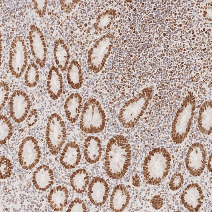 Immunohistochemistry (IHC) staining of human appendicitis tissue using MSH2 Recombinant monoclonal antibody (82775-1-RR)