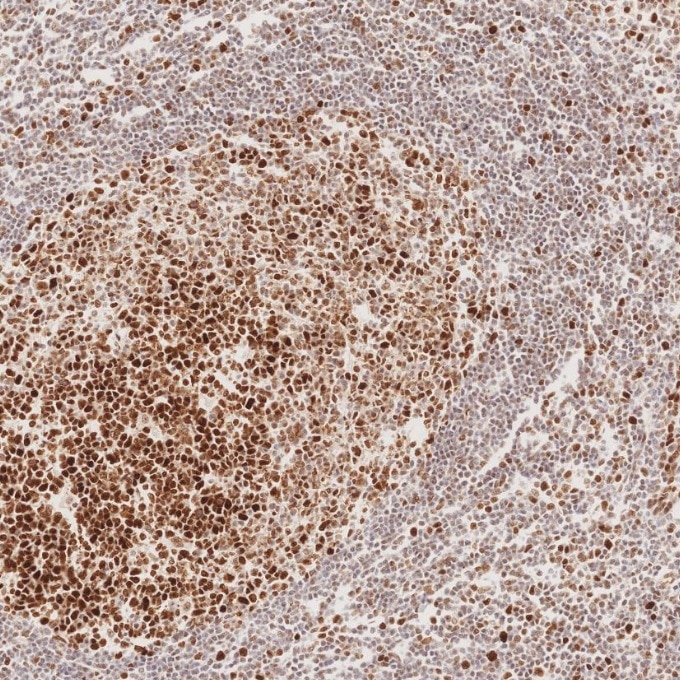 Immunohistochemistry (IHC) staining of human tonsillitis tissue using MSH2 Recombinant monoclonal antibody (82775-1-RR)