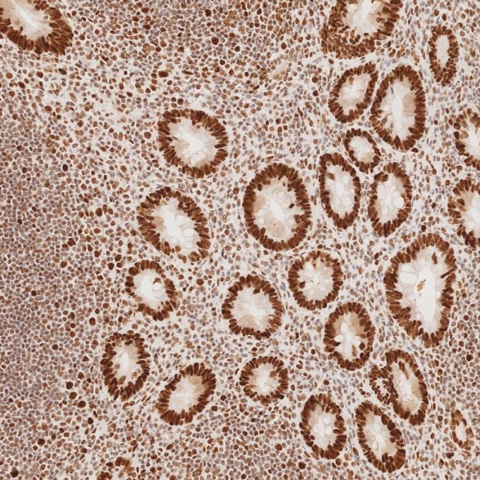 Immunohistochemistry (IHC) staining of human appendicitis tissue using MSH2 Recombinant monoclonal antibody (82775-1-RR)