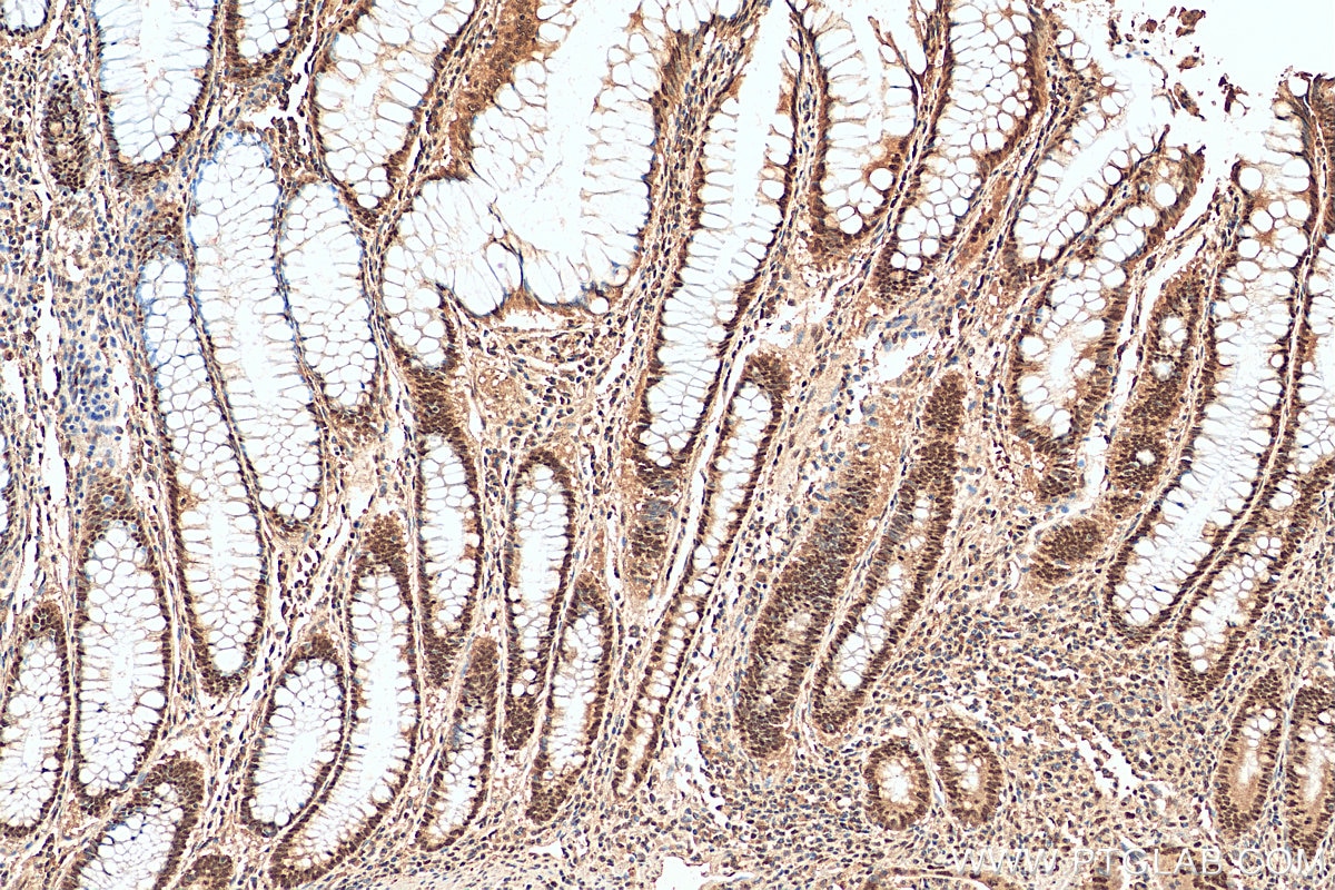 Immunohistochemistry (IHC) staining of human colon cancer tissue using MSH3 Polyclonal antibody (22393-1-AP)