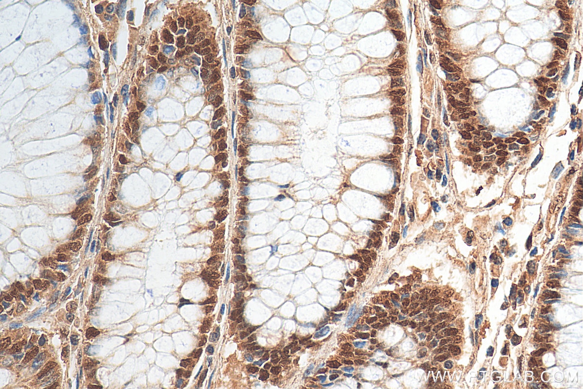 Immunohistochemistry (IHC) staining of human colon cancer tissue using MSH3 Polyclonal antibody (22393-1-AP)