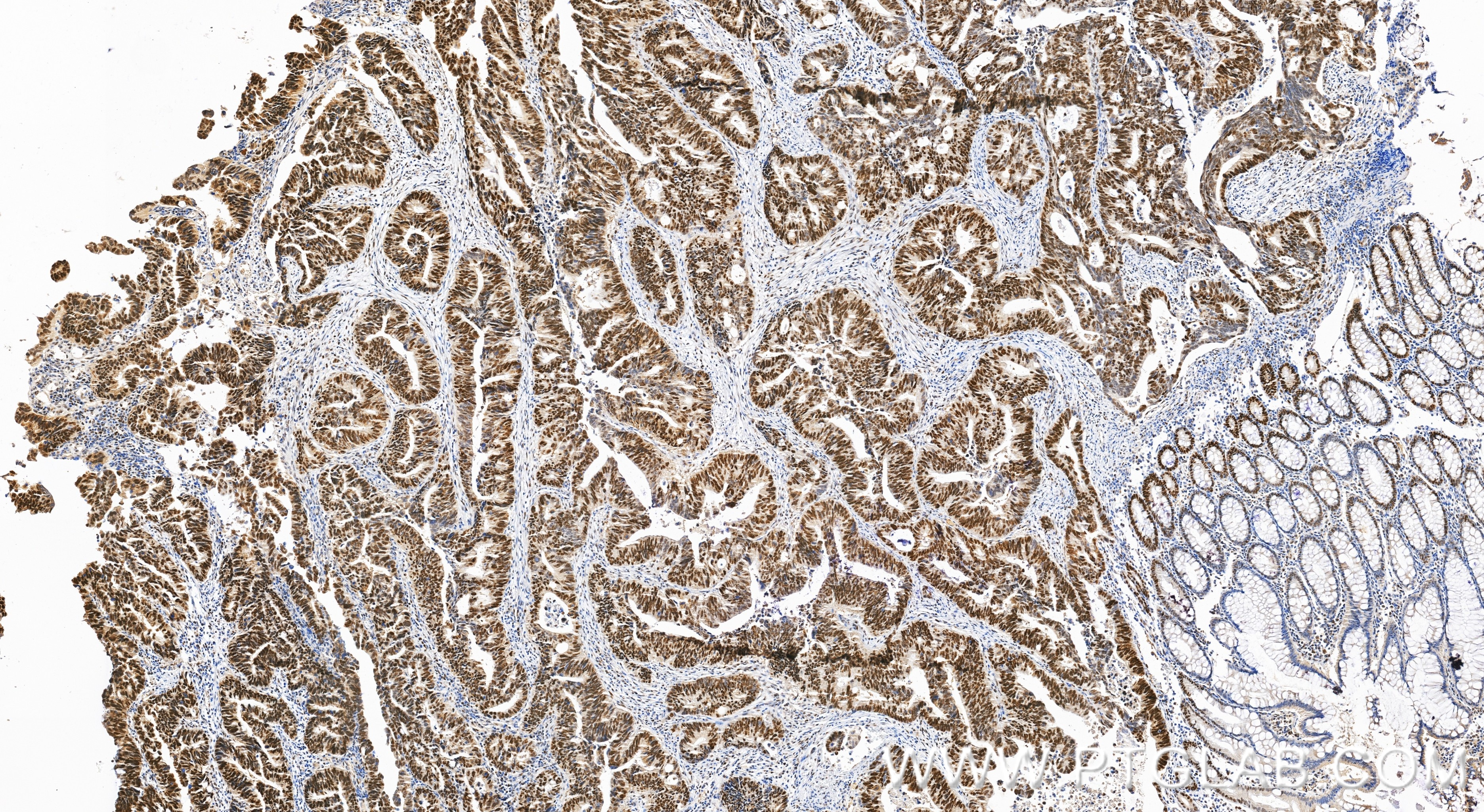 Immunohistochemical analysis of paraffin-embedded human colon cancer tissue slide using 18120-1-AP (MSH6 antibody) at dilution of 1:2000 (under 20x lens). Heat mediated antigen retrieval with Tris-EDTA buffer (pH 9.0). Immunohistochemistry (IHC) staining of human colon cancer tissue using MSH6 Polyclonal antibody (18120-1-AP)