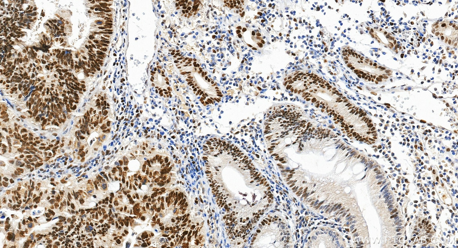 Immunohistochemical analysis of paraffin-embedded human colon cancer tissue slide using 18120-1-AP (MSH6 antibody) at dilution of 1:2000 (under 20x lens). Heat mediated antigen retrieval with Tris-EDTA buffer (pH 9.0). Immunohistochemistry (IHC) staining of human colon cancer tissue using MSH6 Polyclonal antibody (18120-1-AP)