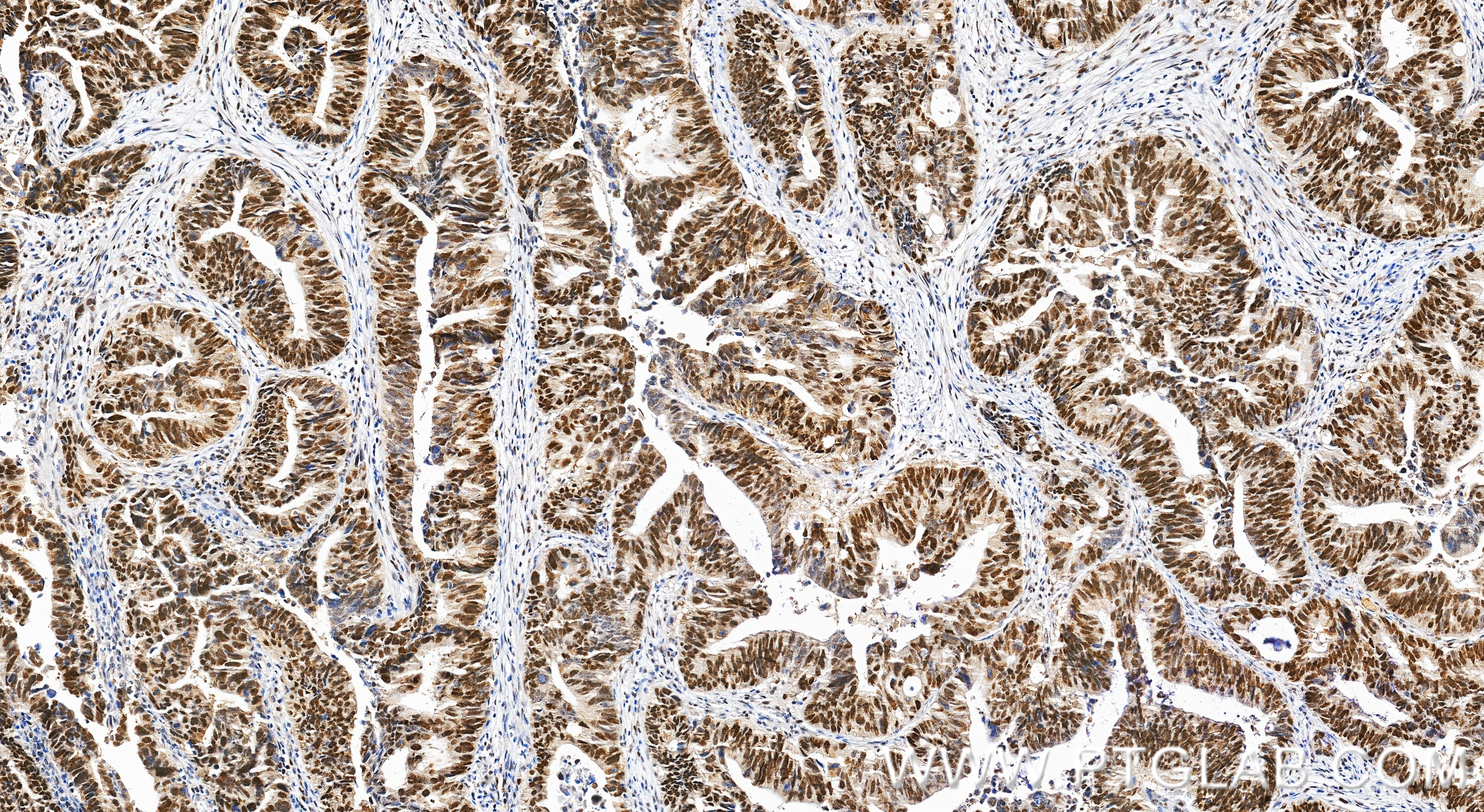 Immunohistochemical analysis of paraffin-embedded human colon cancer tissue slide using 18120-1-AP (MSH6 antibody) at dilution of 1:2000 (under 20x lens). Heat mediated antigen retrieval with Tris-EDTA buffer (pH 9.0). Immunohistochemistry (IHC) staining of human colon cancer tissue using MSH6 Polyclonal antibody (18120-1-AP)