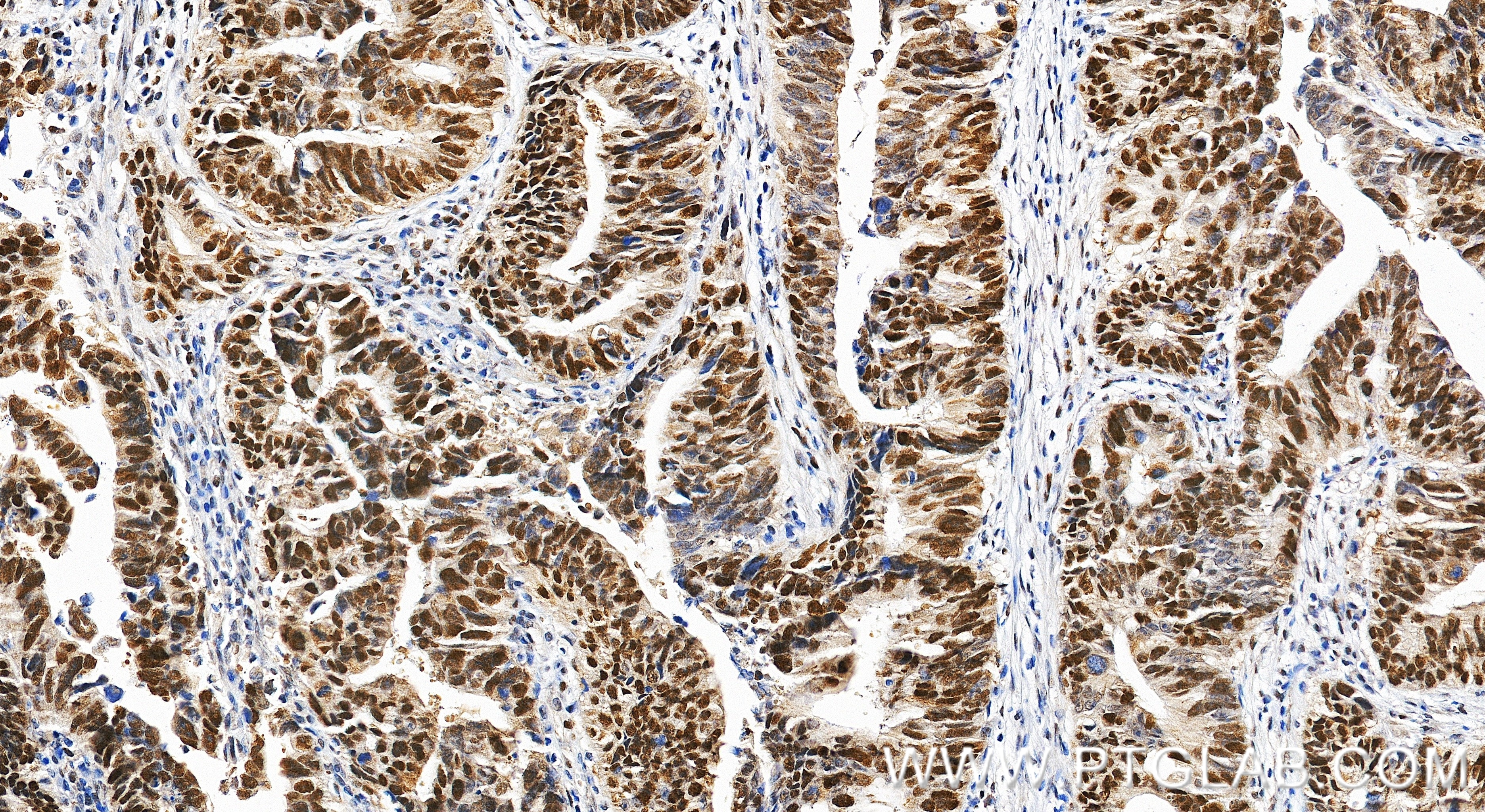 Immunohistochemical analysis of paraffin-embedded human colon cancer tissue slide using 18120-1-AP (MSH6 antibody) at dilution of 1:2000 (under 20x lens). Heat mediated antigen retrieval with Tris-EDTA buffer (pH 9.0). Immunohistochemistry (IHC) staining of human colon cancer tissue using MSH6 Polyclonal antibody (18120-1-AP)