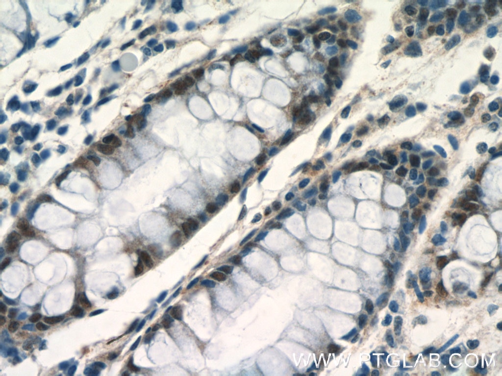 Immunohistochemistry (IHC) staining of human colon tissue using MSH6 Polyclonal antibody (18120-1-AP)