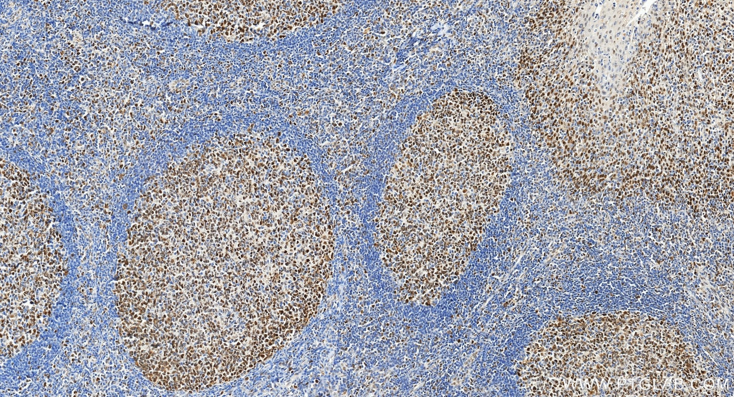 Immunohistochemical analysis of paraffin-embedded human tonsillitis tissue slide using 18120-1-AP (MSH6 antibody) at dilution of 1:2000 (under 20x lens). Heat mediated antigen retrieval with Tris-EDTA buffer (pH 9.0). Immunohistochemistry (IHC) staining of human tonsillitis tissue using MSH6 Polyclonal antibody (18120-1-AP)