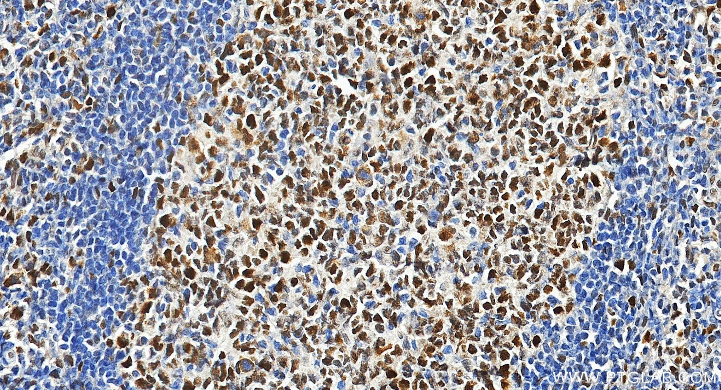 Immunohistochemical analysis of paraffin-embedded human tonsillitis tissue slide using 18120-1-AP (MSH6 antibody) at dilution of 1:2000 (under 20x lens). Heat mediated antigen retrieval with Tris-EDTA buffer (pH 9.0). Immunohistochemistry (IHC) staining of human tonsillitis tissue using MSH6 Polyclonal antibody (18120-1-AP)