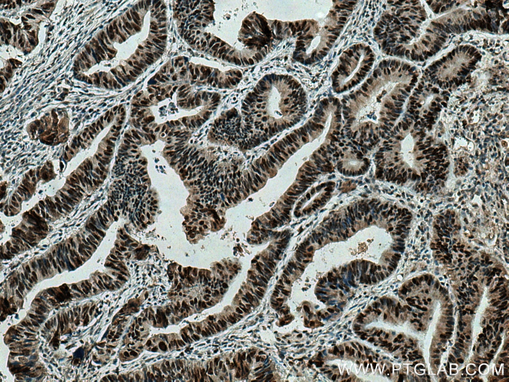 Immunohistochemistry (IHC) staining of human colon cancer tissue using MSH6 Monoclonal antibody (66172-1-Ig)