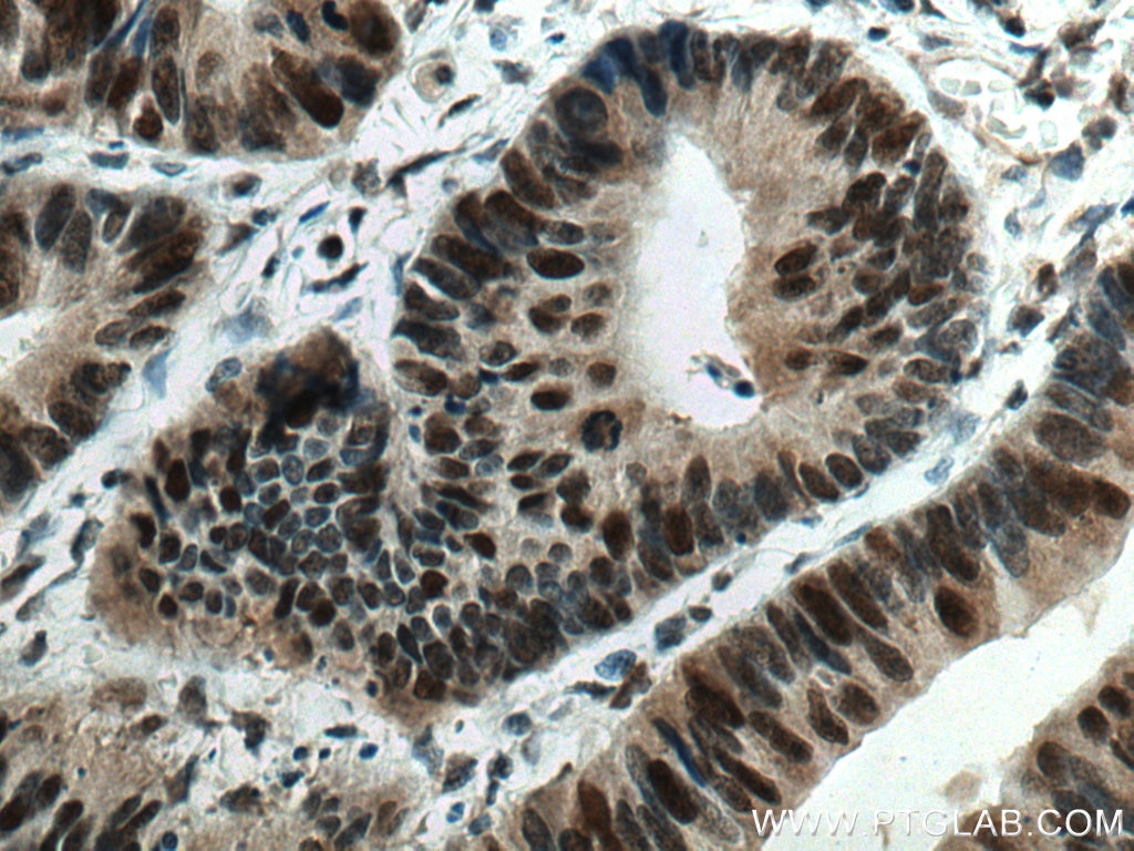 Immunohistochemistry (IHC) staining of human colon cancer tissue using MSH6 Monoclonal antibody (66172-1-Ig)