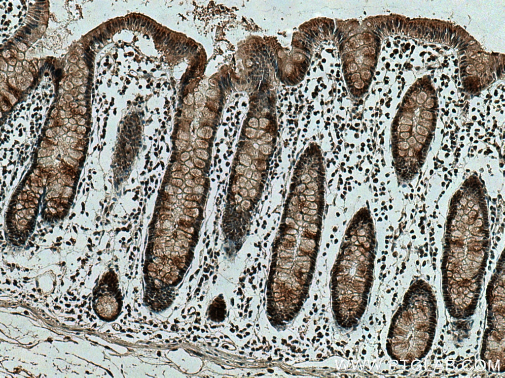 Immunohistochemistry (IHC) staining of human colon cancer tissue using MSH6 Monoclonal antibody (66172-1-Ig)