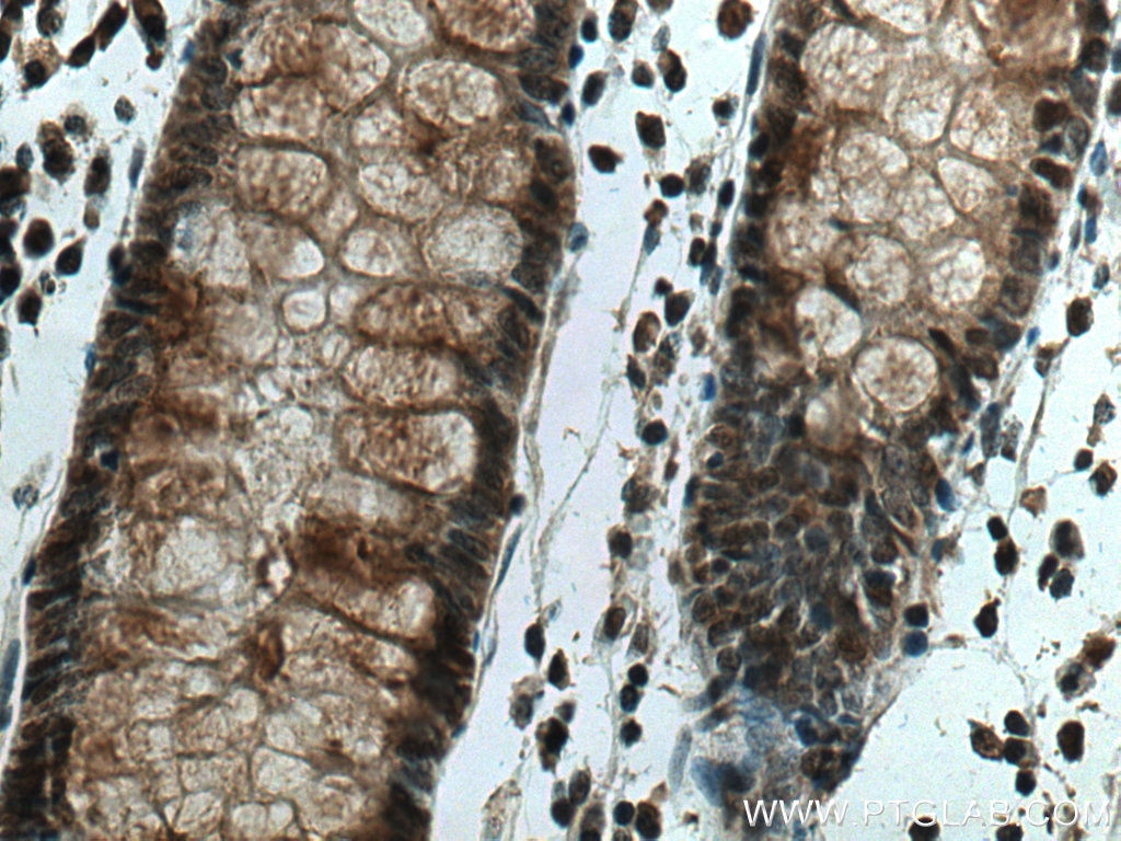 IHC staining of human colon cancer using 66172-1-Ig