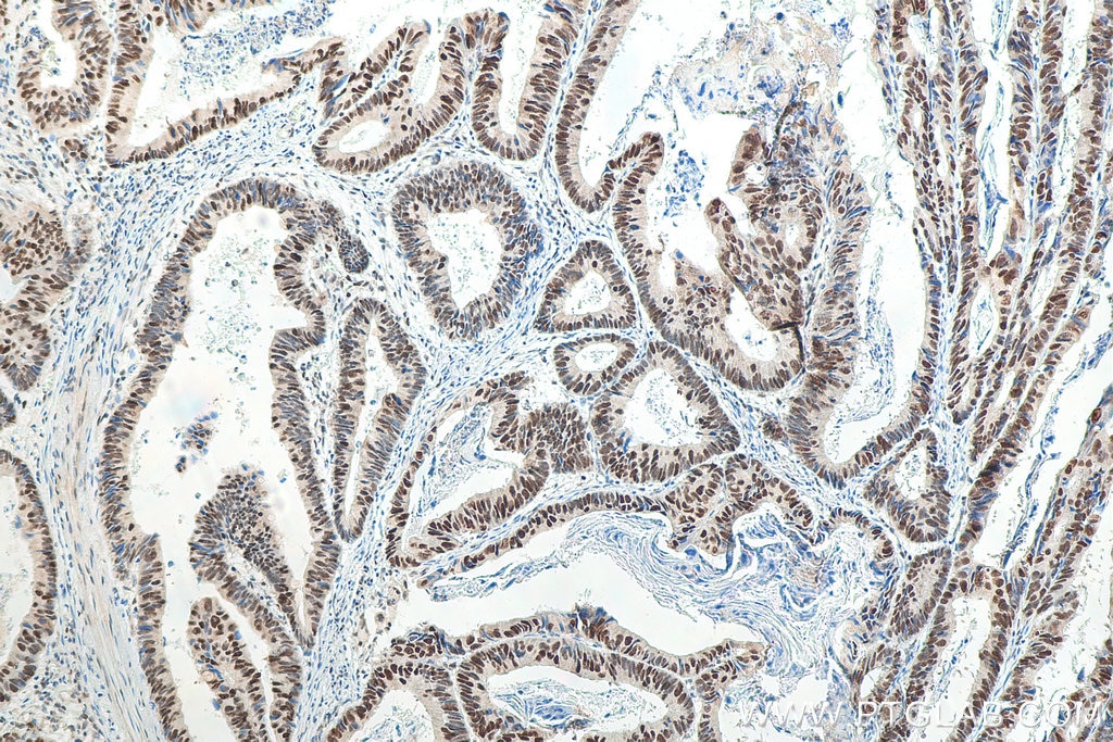 Immunohistochemistry (IHC) staining of human colon cancer tissue using MSH6 Monoclonal antibody (66172-1-Ig)