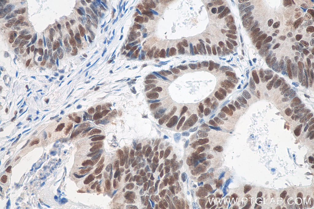 Immunohistochemistry (IHC) staining of human colon cancer tissue using MSH6 Monoclonal antibody (66172-1-Ig)