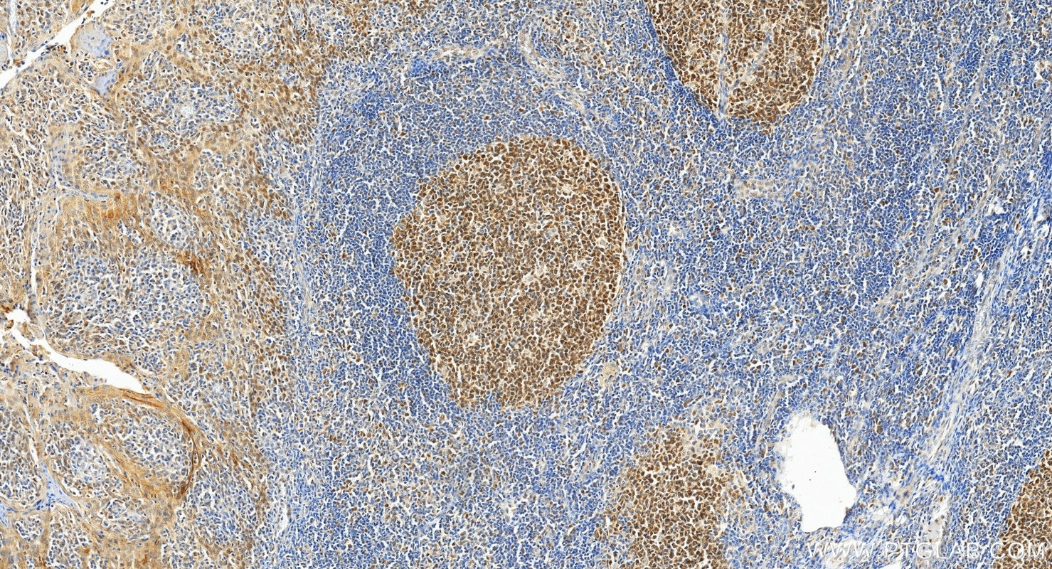 Immunohistochemistry (IHC) staining of human tonsillitis tissue using MSH6 Monoclonal antibody (66172-1-Ig)